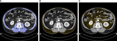 High Systemic Immune Inflammation Index Is Associated With Low Skeletal Muscle Quantity in Resectable Pancreatic Ductal Adenocarcinoma